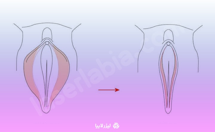 تنگ کردن واژن