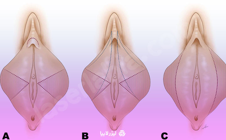 انجام عمل لابیا پلاستی 